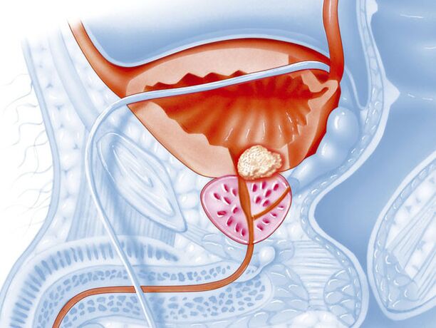Die bakterielle Form von Prostatitis